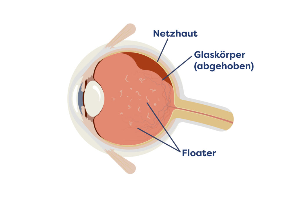 Illustration der Abhebung des Glaskörpers (Glaskörperabhebung)