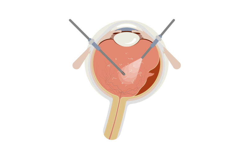 Illustration einer Netzhautoperation (Pars Plana Vitrektomie PPV)