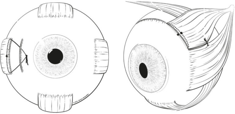 Illustration einer Rücklagerung und einer Umlagerung von Augenmuskeln.